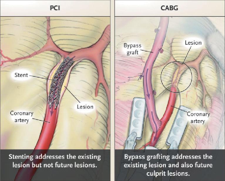Revascularization in Multivessel CAD PCI versus CABG PCI -less invasive -shorter hospitalisation -lower risk of CVA -quality of