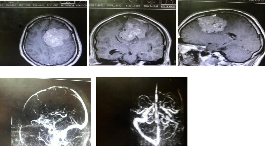 Elzarief and Ibrahim The Egyptian Journal of Neurology, Psychiatry and Neurosurgery (2018) 54:9 Page 3 of 6 a b Fig. 1 a Preoperative MRI with contrast of case no. 5, group B.