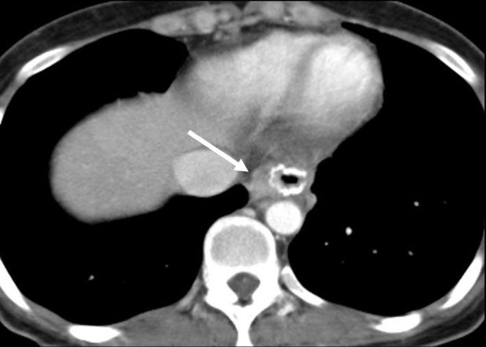 Recurrence in this region manifests as an asymmetrical or circumferential thickening of the anastomotic or remnant gastric wall (Fig. 1) (1).