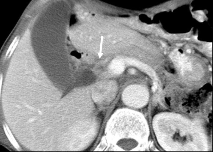 . recurrent lesion at the retropancreatic area (arrow) was not observed on the initial follow-up T because of its similar attenuation with the surrounding