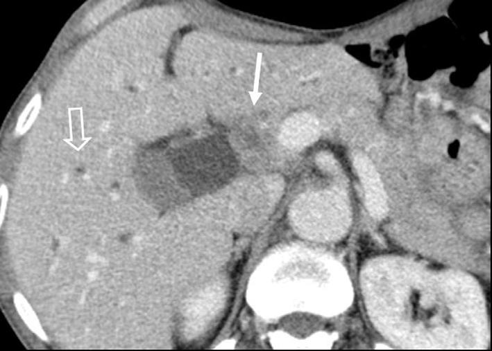64-year-old man presented with jaundice 3.5 years after undergoing gastrectomy to treat adenocarcinoma.