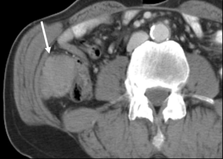 target sign on contrast enhanced T (Fig. Fig. 11. 66-year-old man underwent subtotal gastrectomy to treat adenocarcinoma.
