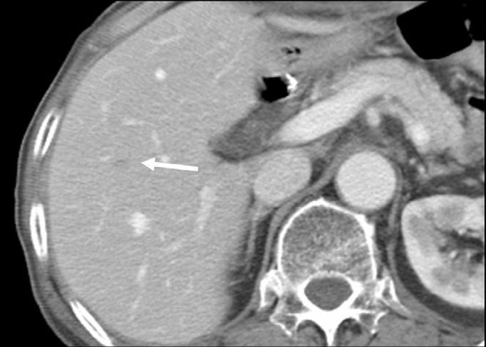 axis, or hepatoduodenal ligament, and peribilary tumors can be identified based on the presence of irregular