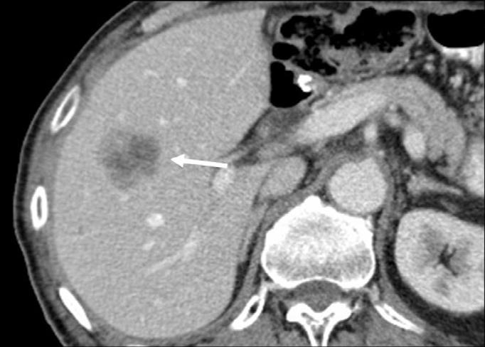 lthough rare, portal venous thrombosis may occur in cases of invasive gastric carcinoma, possibly as a result of