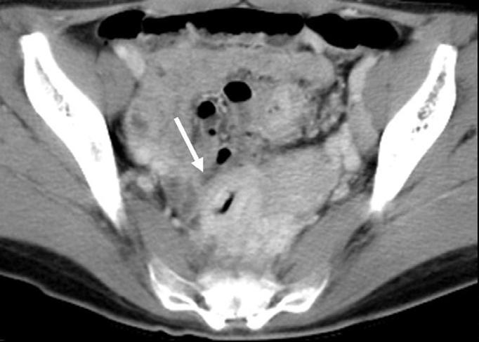 cancer (Fig. 18) (8). Fig. 14. 71-year-old man underwent total gastrectomy to treat adenocarcinoma.