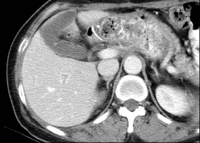 Metastatic bladder tumors can be identified by the presence of polypoid lesions that are similar to typical transitional cell carcinoma