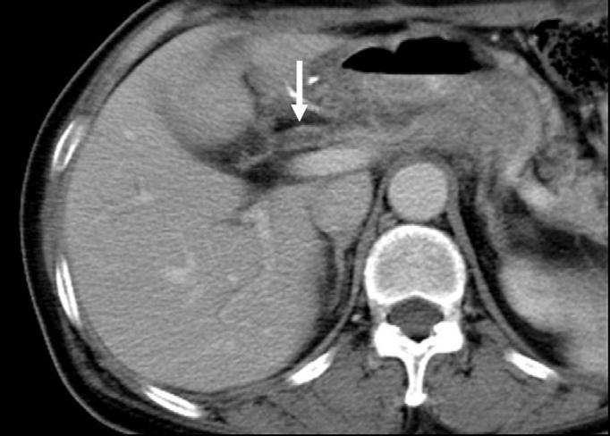 Upon T analysis, ureteral metastasis presents as concentric or asymmetric wall thickening of the ureter with ob- structive