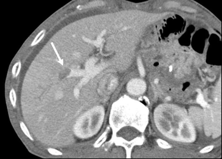 59-year-old woman presented with jaundice 10 months after undergoing a subtotal gastrectomy to treat adenocarcinoma.,.