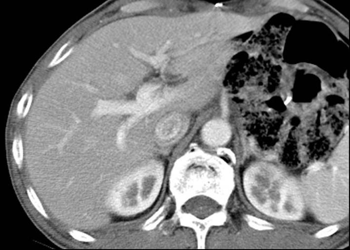 However, on the follow-up T taken 1 month before the onset of jaundice, slight dilatation of the intrahepatic bile duct (open arrow) and