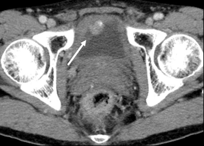 The patient underwent surgery and the pathology of the nodule confirmed the presence of metastatic mucinous adenocarcinoma as a result of stomach cancer. Fig. 20.