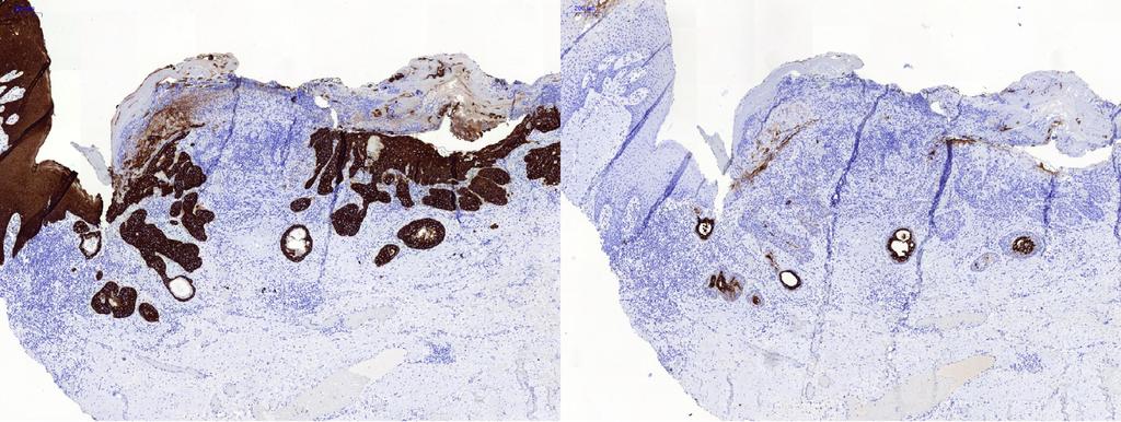 Surgical piece LEFT: HE: ulcerated surface (blue triangle) of the tumor and RIGHT: AB: