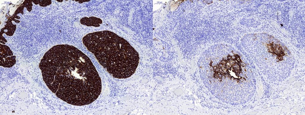Fig. 5. Surgical specimen LEFT: CK5/6 and RIGHT CK7 showing the presence of two distinct cell types. Table I. Histopathological comparison of ASC and MEC.