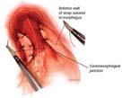 crura) REFLUX: Surgery Belsey - Mark IV thoracic, 280-degree 2 layer