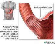 BLEED Ulcer Reflux gastric or duodenal Mallory - Weiss tear h/o repeated