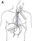 ESOPHAGEAL CANCER: Surgery Transhiateal (THE) blind left neck + abdominal incisions cervical anastomosis all locations Ivor - Lewis (ILE) abdominal + right thoracotomy incisions mid - esophageal
