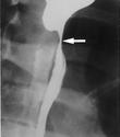CORROSIVE INJURY: Surgery Emergent Laparotomy free air interstitial air in gastric wall signs of perforation (clinical or radiologic) aspiration of alkalotic NG contents from stomach thoracoabdominal