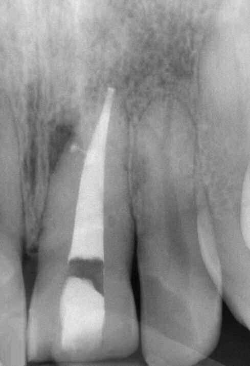 Mismanagement of the apical one-third during canal preparation contributes to obturation overextensions or ghost packs that are scarcely visible or nonexistent.