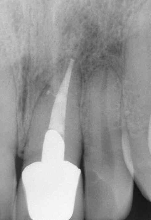 case. This article will analyze the overfill issue as it relates to endodontic success and failure and answer the lingering question: Are overfills good, bad, or ugly?