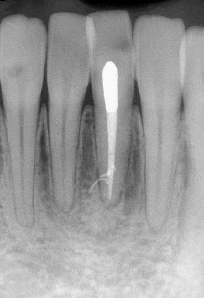 A pre-operative radiograph of the mandibular central incisors reveals a