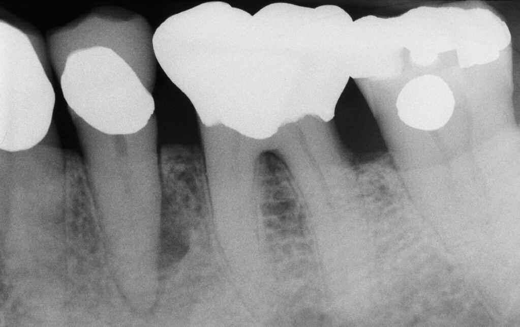 ENDODONTIC OVERFILLS: GOOD? BAD? UGLY? 3 Figure 4a. A pre-operative radiograph of a mandibular second bicuspid reveals a large lateral lesion of endodontic origin. Figure 4b.
