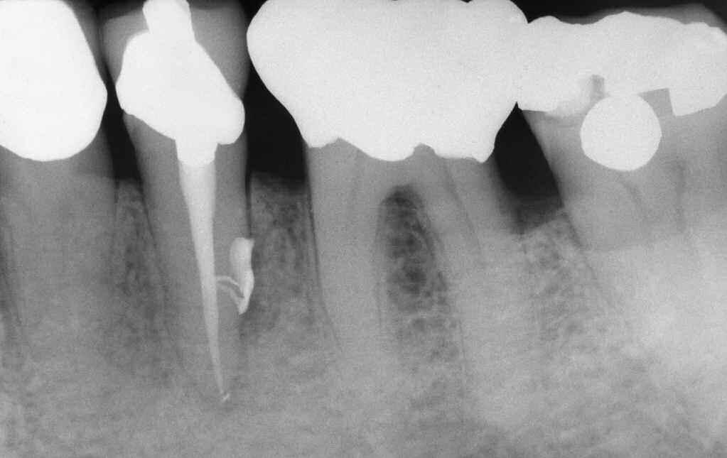 Most dentists were trained to negotiate and prepare the apical one-third of the root canal first using stainless steel files with a.