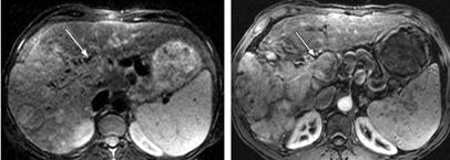 Imaging criteria for diagnosis of HCC Diffuse hepatocellular cancer Finding Sensitivity Specificity Arterial enhancement > 90% 80% Delayed washout Delayed enhancing capsule Bright lesion on T2 images