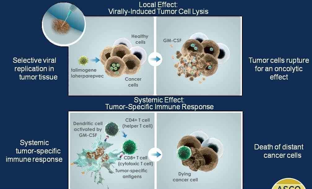 T-VEC: An HSV-1-Derived Oncolytic Immunotherapy Designed to Produce Local and Systemic Effects Local Effect: Virally-Induced Tumor Cell Lysis Selective viral replication in tumor tissue Tumor cells