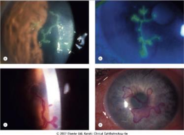 HSVeK HSV reactivation that involves only the corneal epithelium May be plaque like, dendritic, or