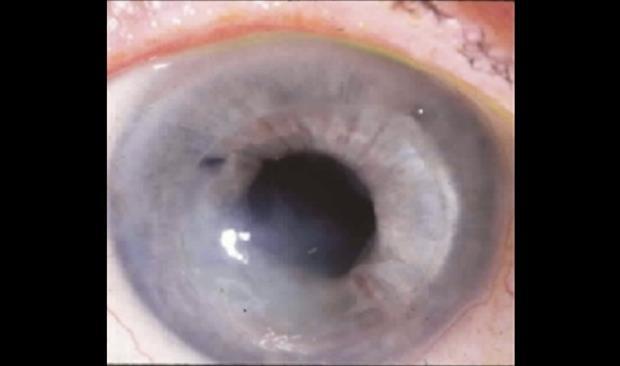 HSV affecting the corneal stroma Can be associated with epithelial keratitis or be the initial presentation Majority of cases are immune mediated Stromal infiltrate with intact