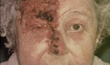 Varicella The shingles Virology review HZO When the