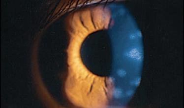 HZO May cause Eyelid swelling Keratitis Scleritis Uveitis Trabeculitis Retinal necrosis Papillitis Nerve palsies Cavernous
