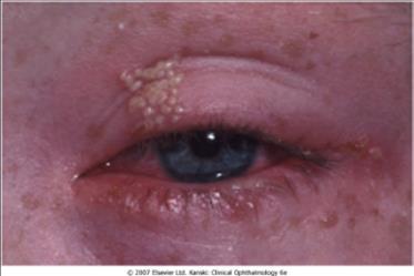 Primary Infection Pustules
