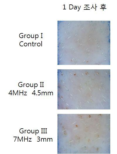 (Figure 4. 24 hours after irradiation (Day 1) Dermoscope picture showed no adverse reaction from the skin surface or skin burns.