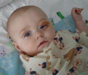 Peak age 2-3 yrs MALIGNANT MASSES v Neuroblastoma Ill appearing Horner s syndrome,