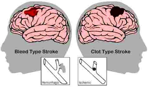 STROKE Stroke is a brain injury caused by a sudden interruption in the blood supply of the brain. Stroke is serious, just like a heart attack and is sometimes called a "brain attack.