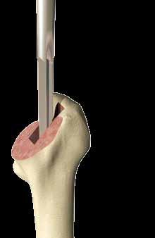 Depth markers Size 10 Size 4 Size 0 Male Female Step 4. Tapered IM reamer Use the T-handled tapered reamer to open the natural axis of the femoral canal for broach preparation.