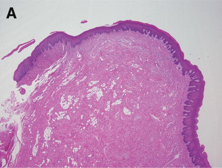 Case Reports in Pathology 3 (a) (b) Figure 4: Histological findings of the lesion.
