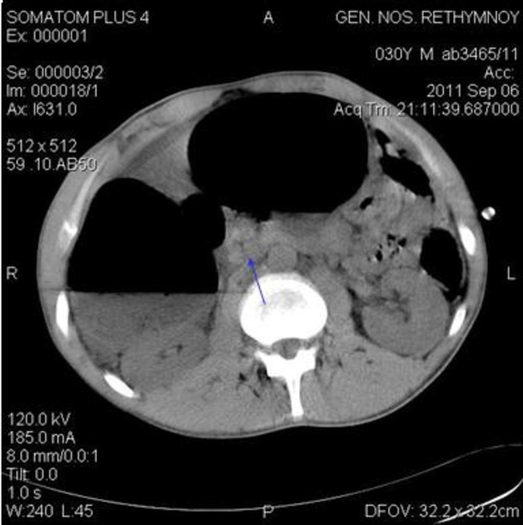 Fig. 7: Cecal volvulus: Scanogram shows a focal round loop of air-distended bowel with haustral markings displaced in the mid-abdomen, corresponding the dilated twisted cecum (black arrow) (fig.5).