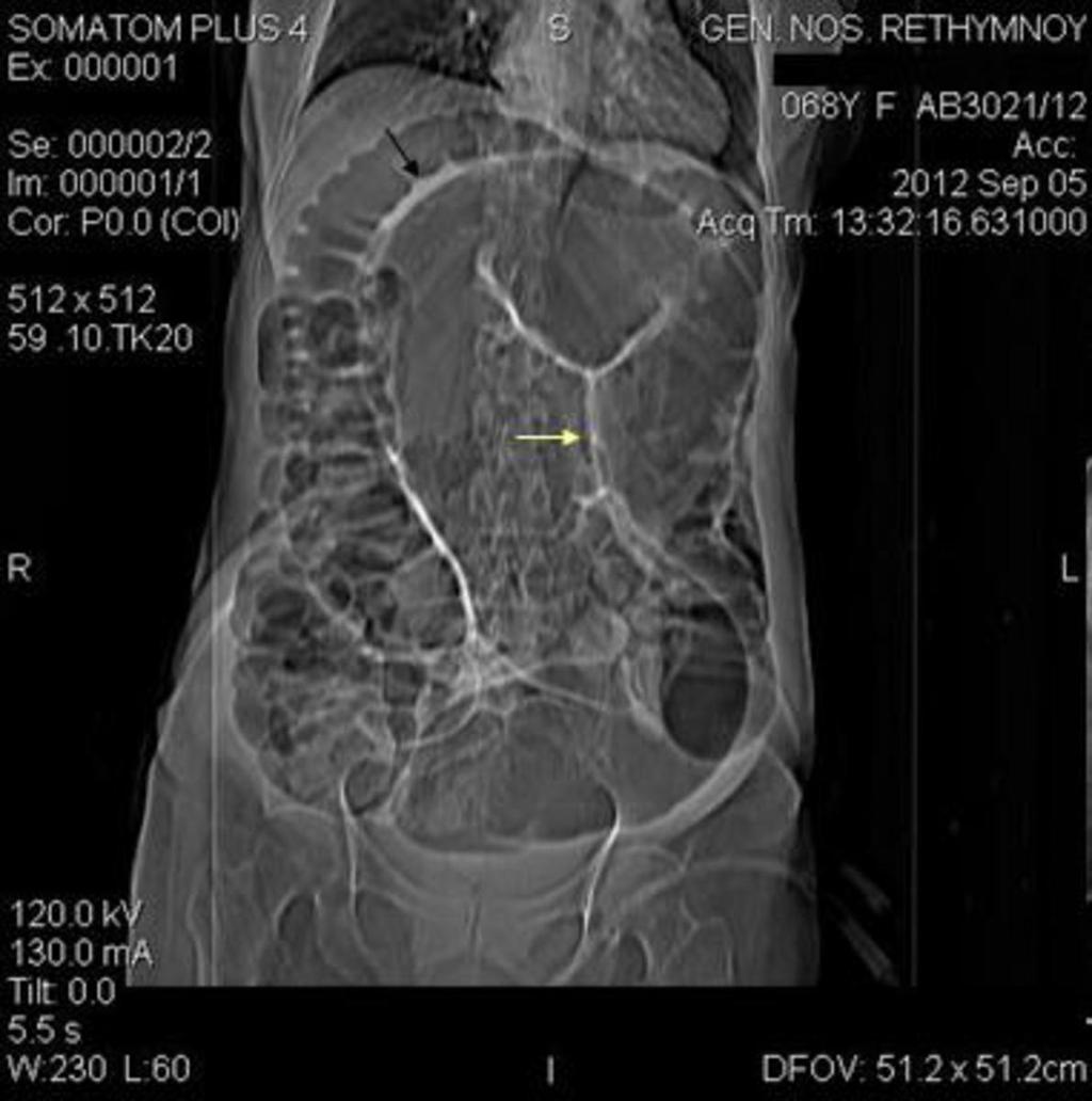 Fig. 9: Sigmoid volvulus: Scanogram shows a dilated sigmoid colon arising from the pelvis, with its apex in the right upper quadrant of the abdomen (black arrow).