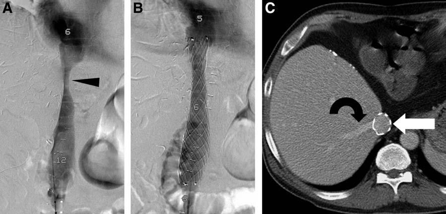 EFFICACY OF STENT PLACEMENT FOR TREATING STENOSIS 517 Figure 1. Patient number 5. (A) Preprocedural cavogram shows hepatic segmental vena caval stenosis (arrowhead).