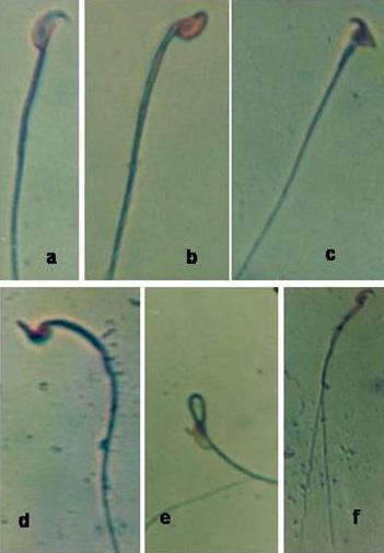 fragmentation. Giemsa stain, 1000X. Figure 3. Photomicrograph showing different sperm abnormalities. a) Normal sperm, b) hook-less, c) amorphous, d) bananashaped, e) folded, and f) two-tailed sperms.