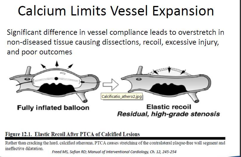 Clinical Limitations & Unmet Needs Calcium as a Barrier Longer Lesion Length Calcium Limits Vessel Expansion 1