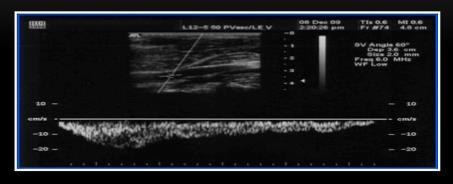 Spontaneous flow Present in all normal veins Absence of spontaneous