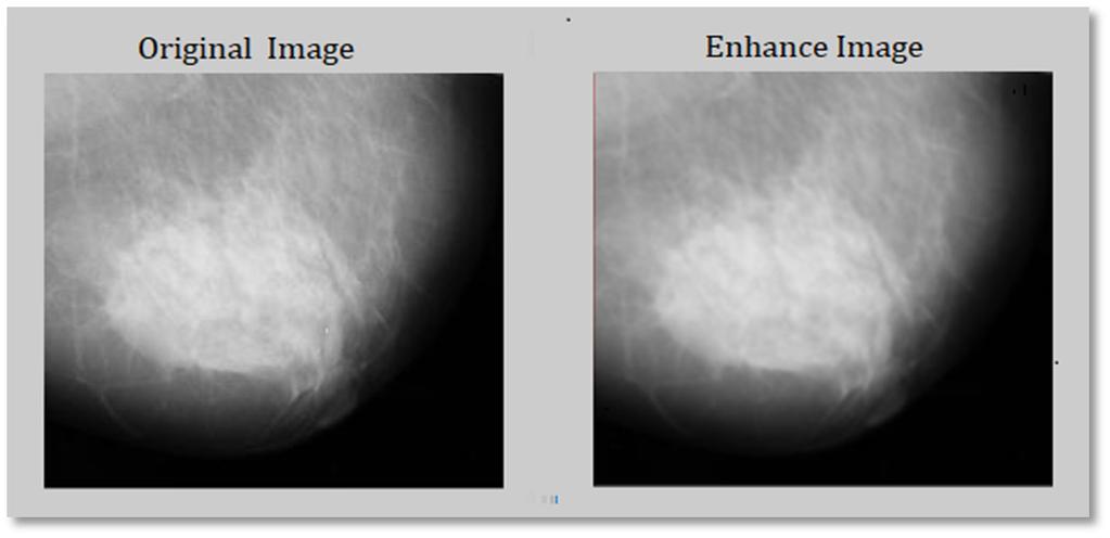 3.2.1. Enhancement the Image The Mammogram image like any other images suffered from the noise. The average filter is used to remove the unwanted noise.