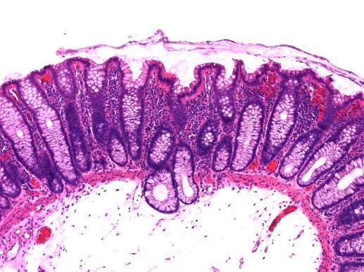 Epithelial misplacement