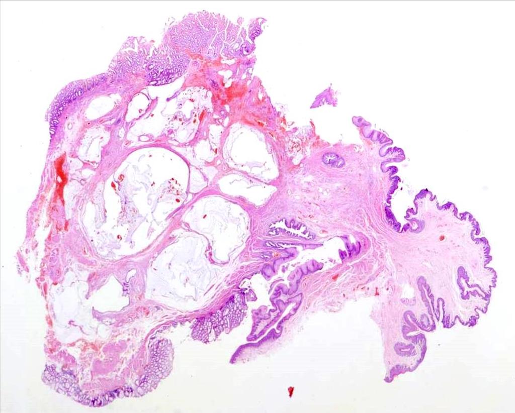Polypoid mucosal prolapse lower rectal/anal most common: inflammatory cloacogenic polyp epithelial (villous) hyperplasia traps the unwary into calling them large villous
