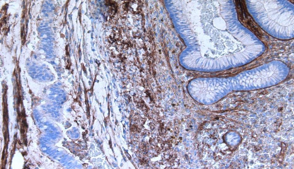 Immunohistochemistry works well in classic cases of pseudoinvasion and cancer not so good in marginal