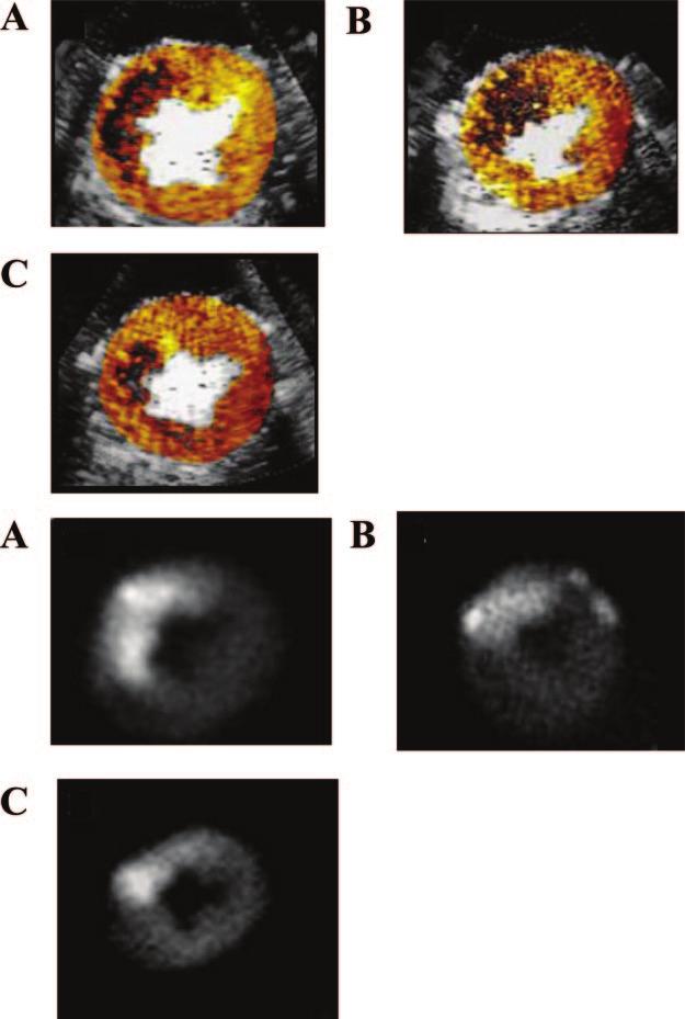 302 Circulation July 15, 2008 Figure 10. Top, MCE-derived no-reflow images from dogs receiving saline (A) (group 1), tirofiban (B) (group 2), and CP-4715 (C) (group 3). See text for details.