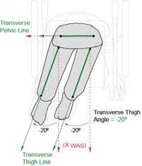 hip flexion angle Using Terms for Joint Motion Windswept Clinical Application Guide (Aug 2013) CONTENTS