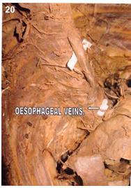 Intercostal veins draining